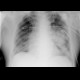 Pneumonia: X-ray - Plain radiograph